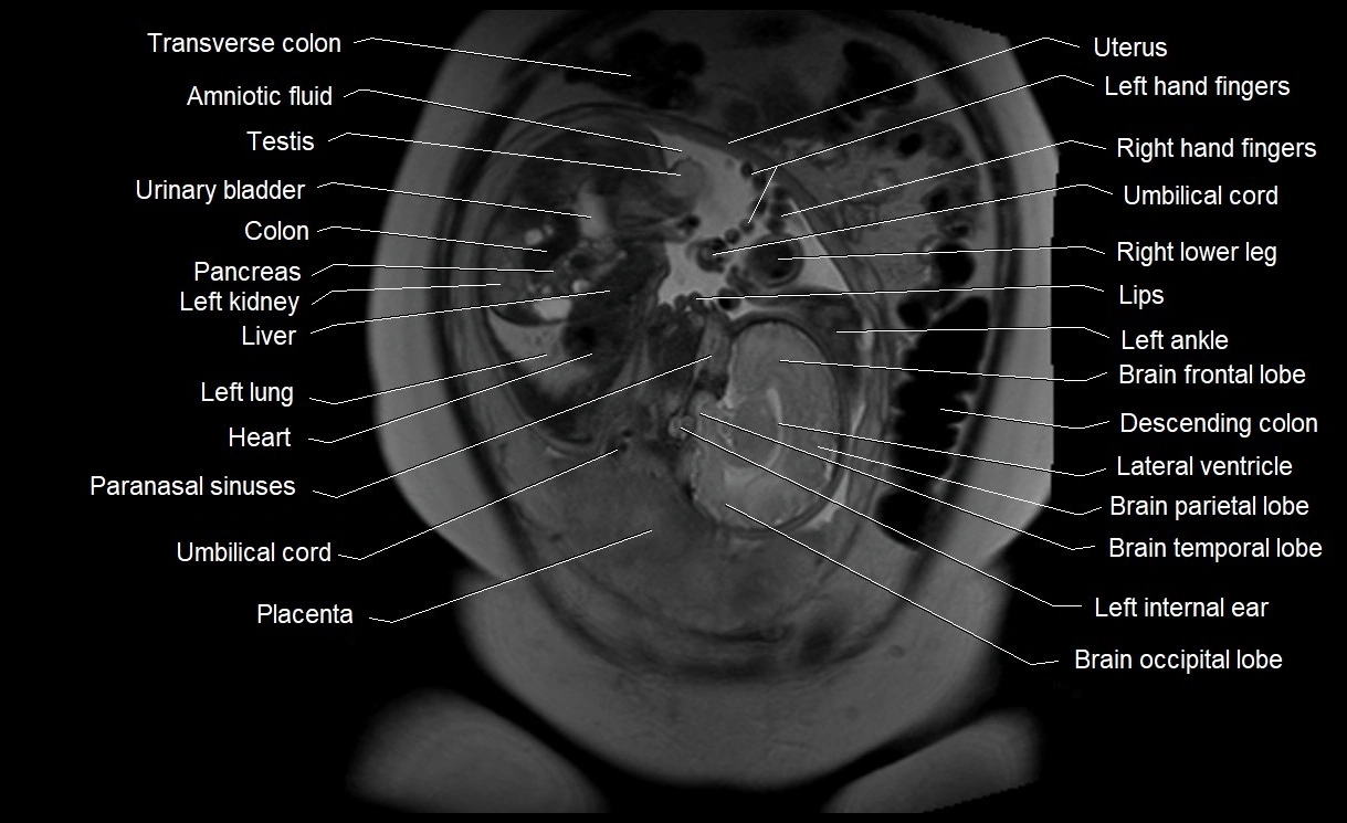 MRI Anatomy of pregnancy image 10.webp